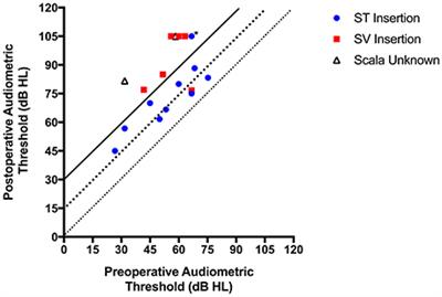 Intra- and Postoperative Electrocochleography May Be Predictive of Final Electrode Position and Postoperative Hearing Preservation